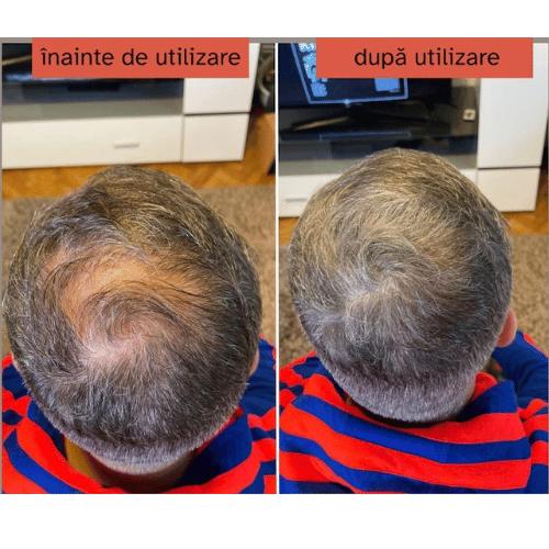 Extra-Hair inainet si dupa utilizare (1)